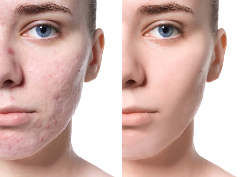 Acne Scar Laser Treatment in Delhi​
