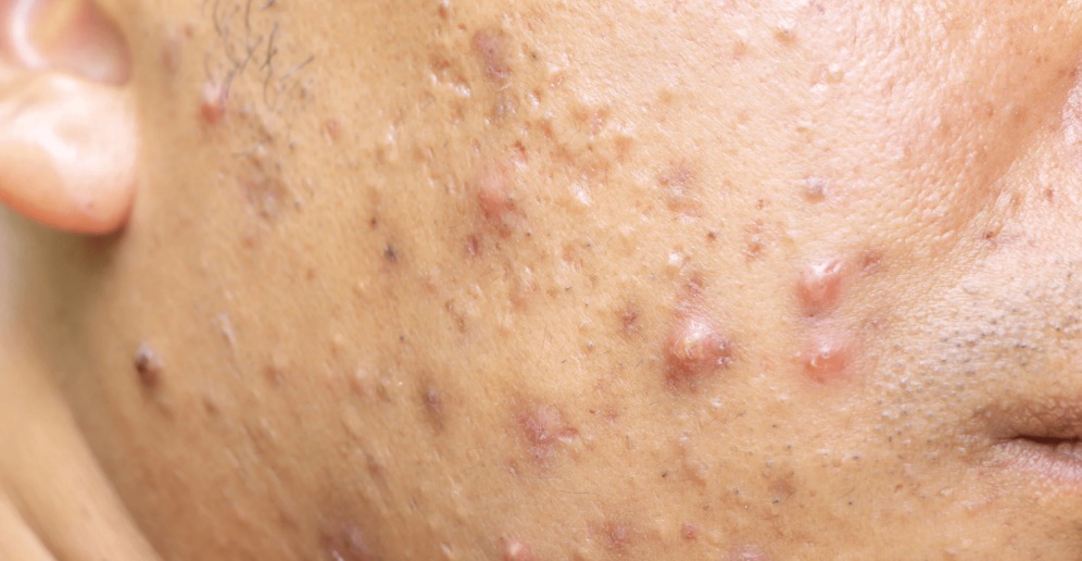 Best Acne Scar Treatment in Delhi​