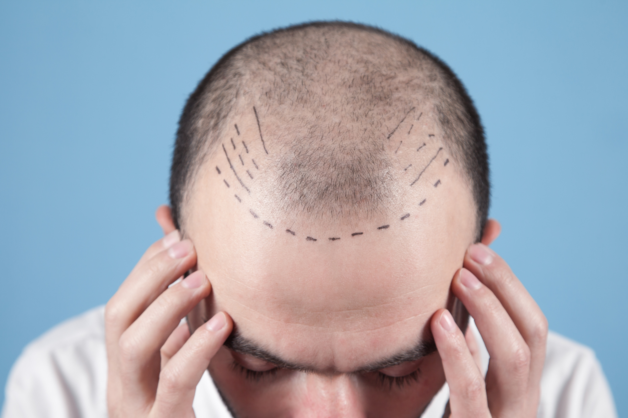 Delhi best hair transplant doctor​