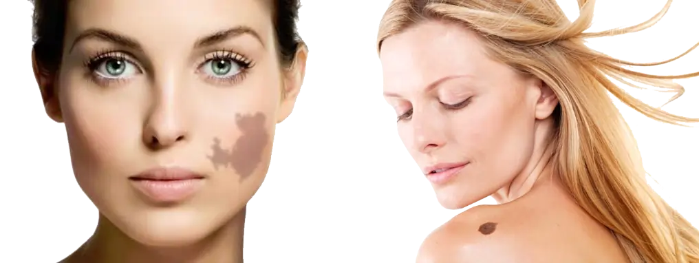 Best Birth Stretch Mark Removal Treatment Clinic