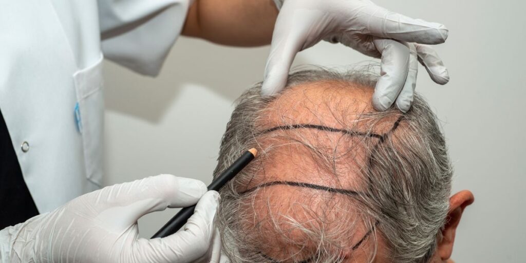 best hair transplant clinic in Delhi