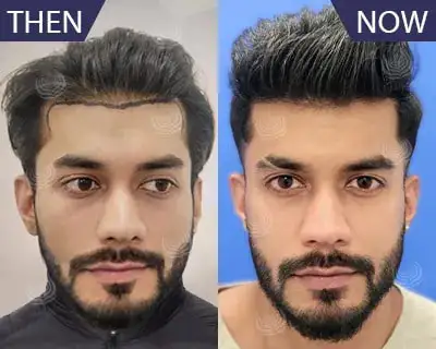 best hair transplant clinic in Delhi