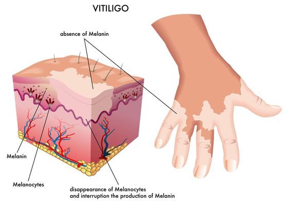 Best Vitiligo Specialist in Delhi
