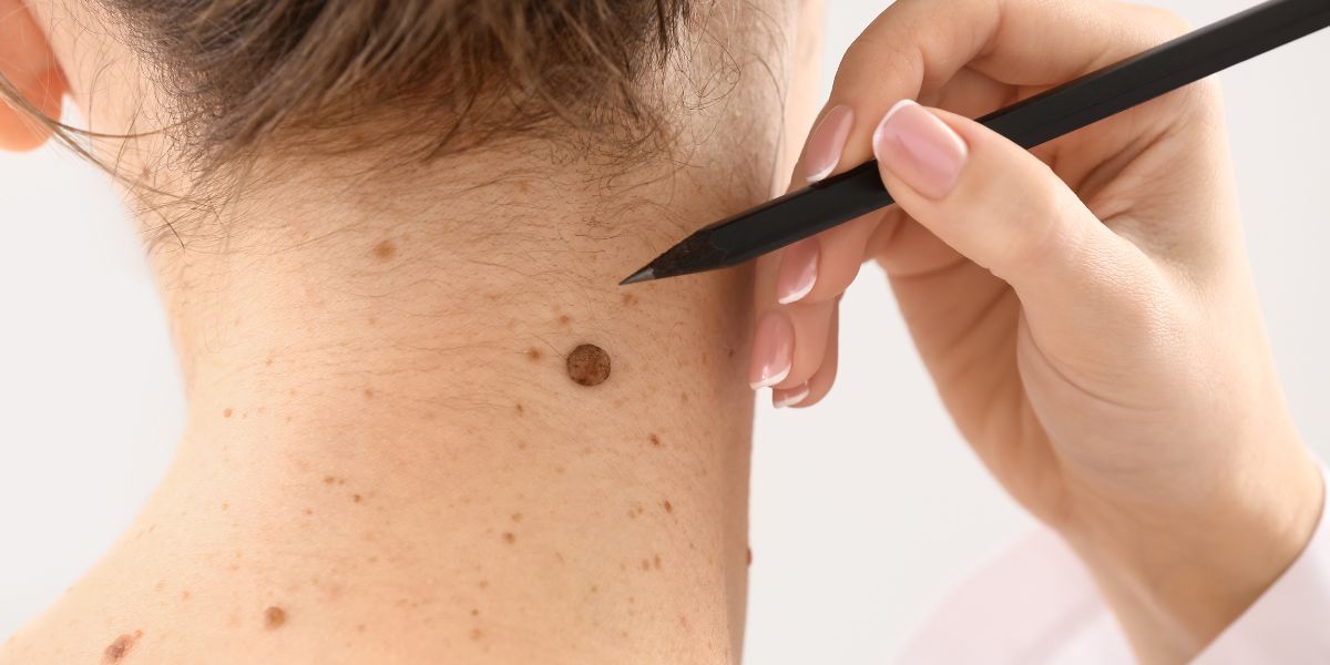 Birth Marks Removal Treatment in Uttam Nagar