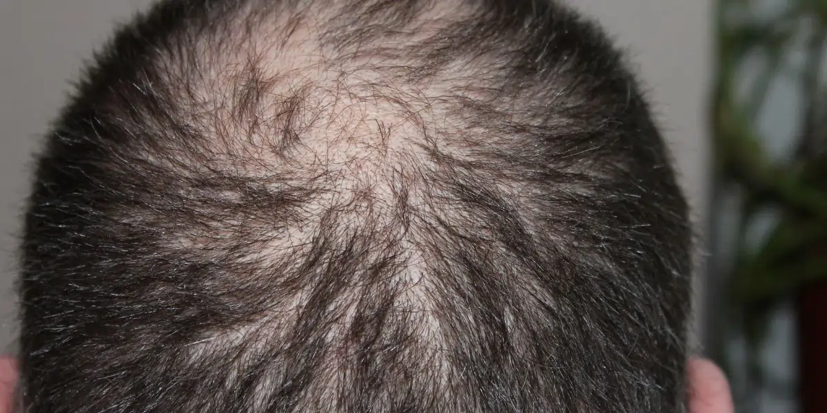 What to Expect Before, During, and After a Hair Transplant